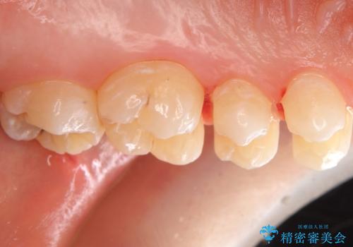 放置した虫歯 セラミックインレーでの治療の治療中