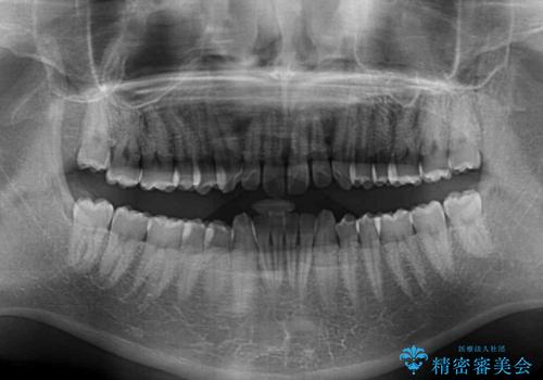 デコボコとディープバイトを治したい インビザラインによる矯正治療の治療前