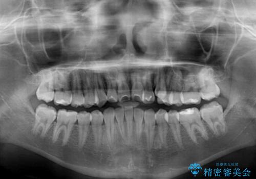 目立つ八重歯を治したい インビザラインによる矯正治療の治療前