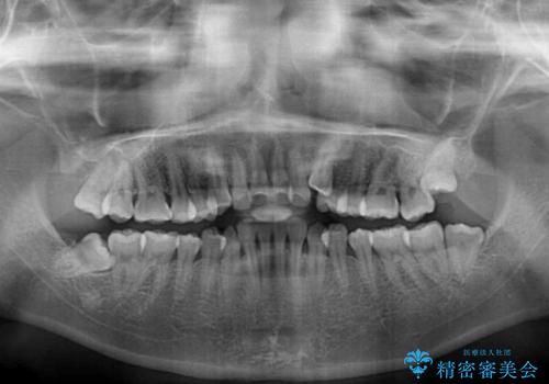 狭い歯列を拡大 拡大装置を併用したインビザライン矯正の治療前