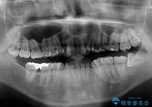 見えないほど重なっている前歯 抜歯矯正でスッキリとした歯並びにの治療前