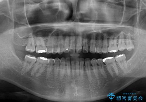 隙間の空いた前歯を閉じたい インビザライン矯正の治療前
