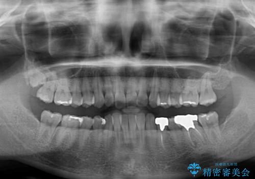 ディープバイトとデコボコを解消 インビザライン矯正の治療前