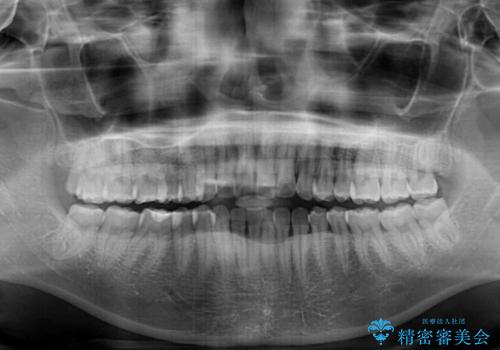 上下前歯の前歯と腫れやすい歯肉 インビザライン矯正で改善の治療前