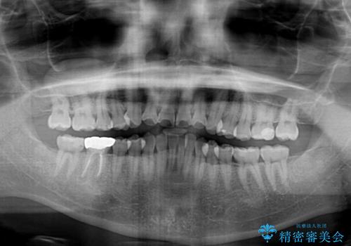 早くて安くて楽ちん メタルブラケットでの矯正治療の治療前