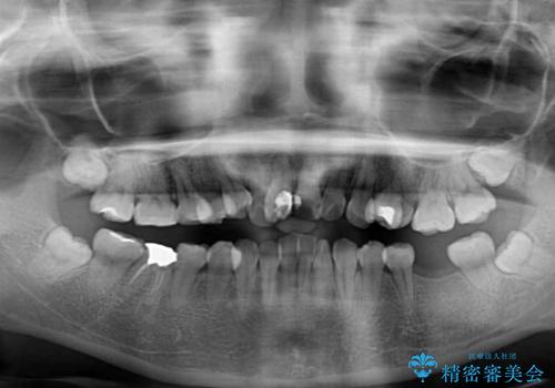 虫歯と抜いたままの奥歯とデコボコの前歯 総合歯科治療の治療前