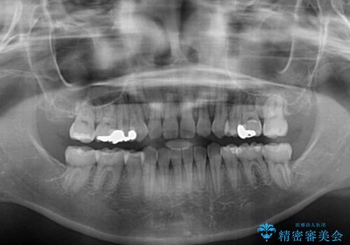 閉じにくい口元と八重歯 ワイヤー装置での抜歯矯正の治療後