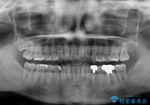 ディープバイトとデコボコを解消 インビザライン矯正の治療後