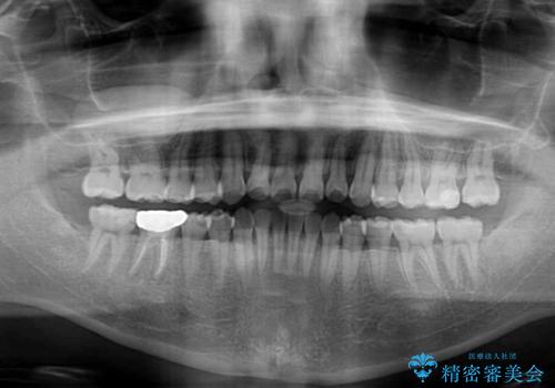 早くて安くて楽ちん メタルブラケットでの矯正治療の治療後