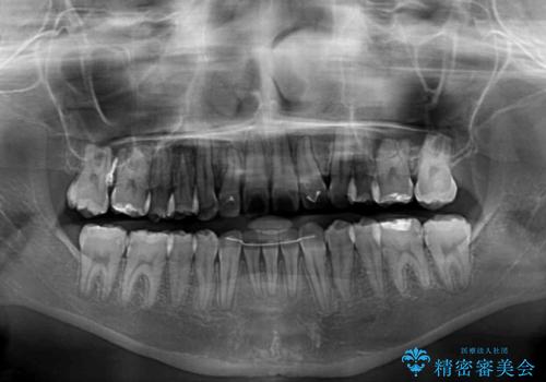 目立つ八重歯を治したい インビザラインによる矯正治療の治療後