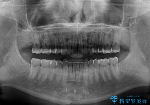 デコボコとディープバイトを治したい インビザラインによる矯正治療の治療後