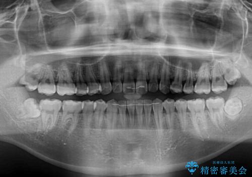 軽微叢生をインビザラインで 廉価版パッケージでの矯正治療の治療後