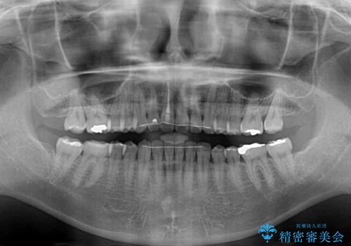 隙間の空いた前歯を閉じたい　インビザライン矯正の治療後