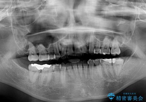 見えないほど重なっている前歯　抜歯矯正でスッキリとした歯並びにの治療後