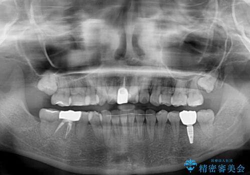 虫歯と抜いたままの奥歯とデコボコの前歯 総合歯科治療の治療後