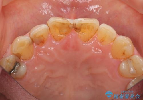 目立つ前歯の変色を改善したいの治療前
