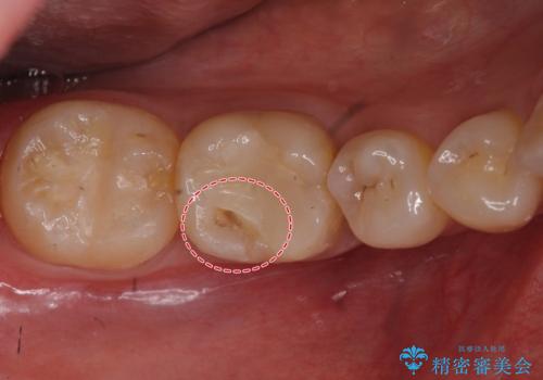 欠けた詰め物　セラミッククラウンでの修復