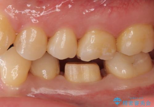 奥歯の詰め物の変色 セラミッククラウンでのやり替えの治療中