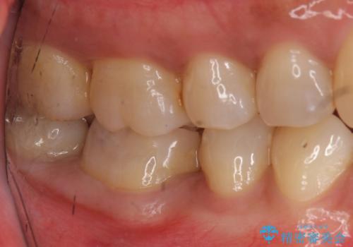 欠けた詰め物 セラミッククラウンでの修復の治療前