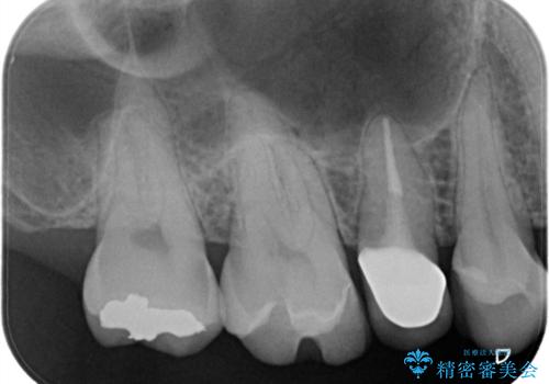 【セラミックインレー】虫歯の治療の治療前