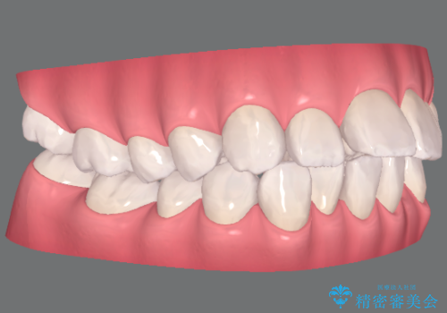 インビザラインで出っ歯の治療