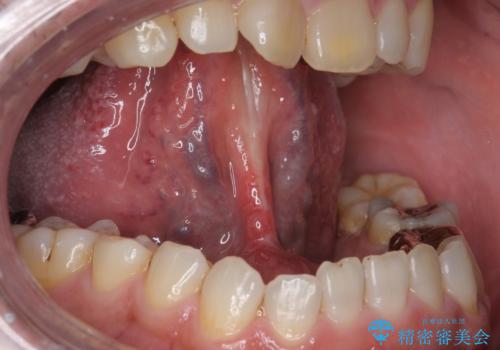 滑舌の悪さを　舌小帯形成術　で改善の症例 治療後
