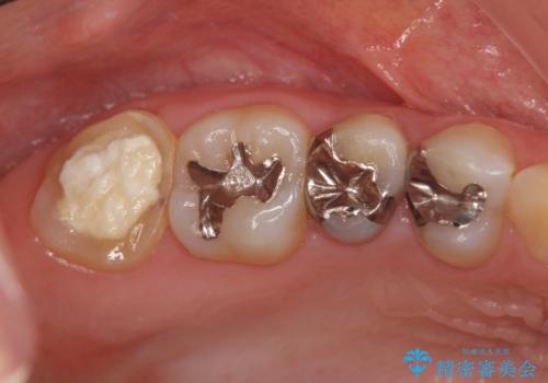 [ 深い虫歯・根管治療・セラミッククラウン ]複合した問題を持った虫歯治療の治療前