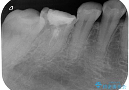 【精密根管治療】間違った根管形成→パフォレーションリペアによる修復 の治療前