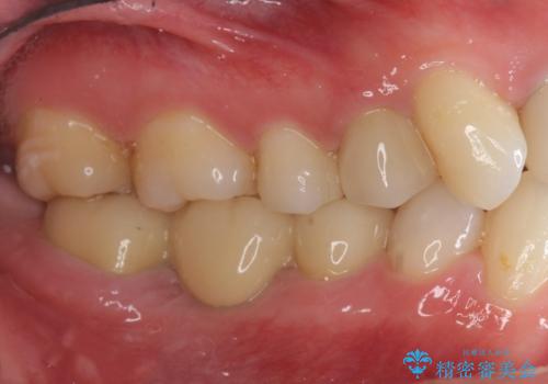 放置した虫歯 ブリッジ治療の治療後