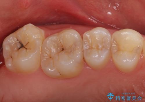 放置した虫歯 セラミックインレーでの治療の治療前