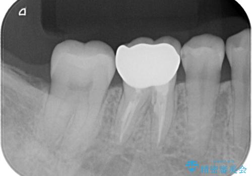 【精密根管治療】間違った根管形成→パフォレーションリペアによる修復 の治療後