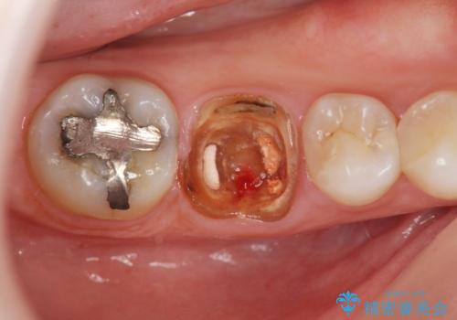 放置した虫歯　ブリッジ治療の症例 治療前