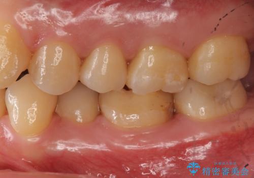 奥歯の詰め物の変色 セラミッククラウンでのやり替えの治療前