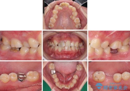 虫歯と抜いたままの奥歯とデコボコの前歯　総合歯科治療の治療前