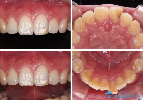 気になる前歯を短期間で改善 下顎の部分矯正と上顎のオールセラミッククラウンの治療前