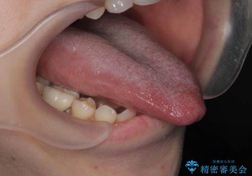 [ 舌小帯の形成 ]  滑舌の改善をしたいの治療後
