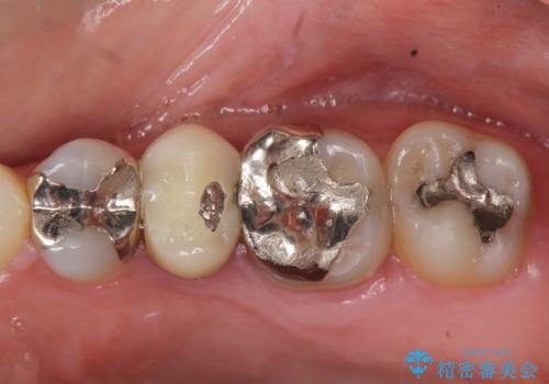 目立つ銀歯を白くしたいの症例 治療前