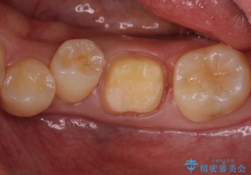 奥歯の詰め物の変色 セラミッククラウンでのやり替えの治療中