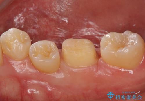 奥歯の詰め物の変色 セラミッククラウンでのやり替えの治療中