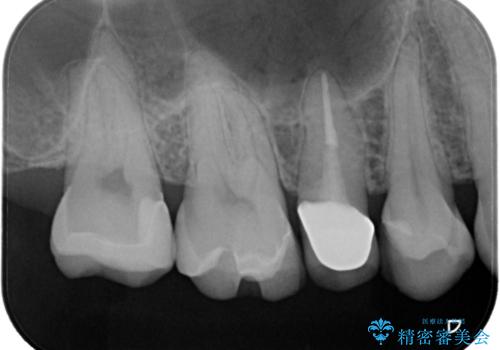 【セラミックインレー】虫歯の治療の治療後