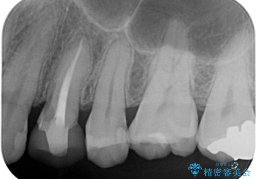 【保険治療したところが再び虫歯に】セラミックインレーで治療の治療前