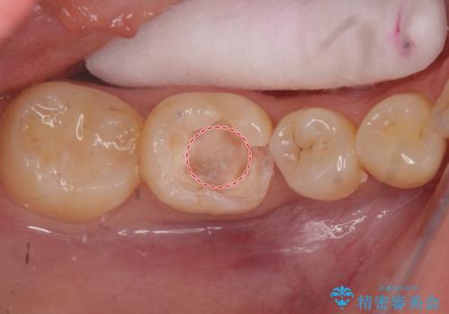 欠けた詰め物 セラミッククラウンでの修復の治療中