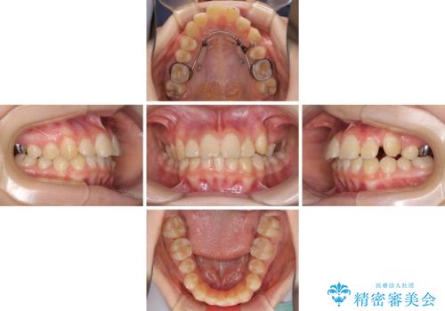 目立つ八重歯を治したい インビザラインによる矯正治療の治療中