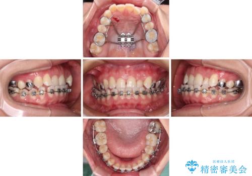 前歯の反対咬合 急速拡大装置とワイヤー装置であっという間の矯正治療の治療中