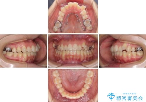 狭い歯列を拡大 拡大装置を併用したインビザライン矯正の治療中