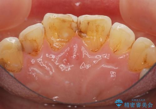 目立つ前歯の変色を改善したいの治療前