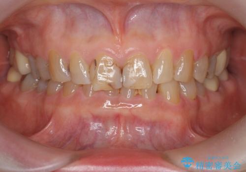 目立つ前歯の変色を改善したいの治療前