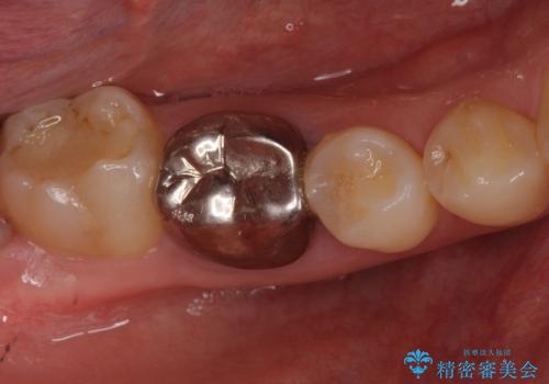 銀歯を白くしたい　セラミッククラウンでのやり替えの症例 治療前