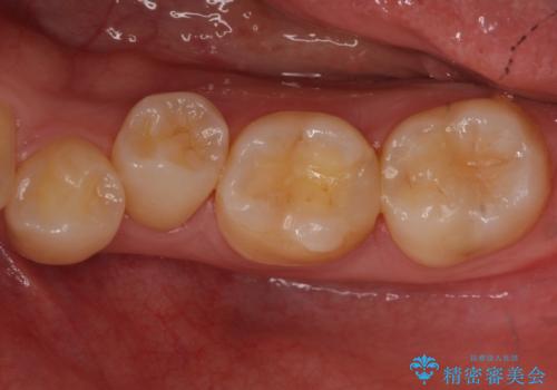 奥歯の詰め物の変色　セラミッククラウンでのやり替えの治療前