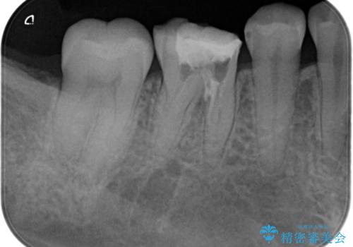 【精密根管治療】間違った根管形成→パフォレーションリペアによる修復 の治療前